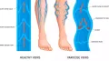 Varicose veins are far more common than most people realize, yet they remain shrouded in unnecessary fear and misconceptions. While these enlarged