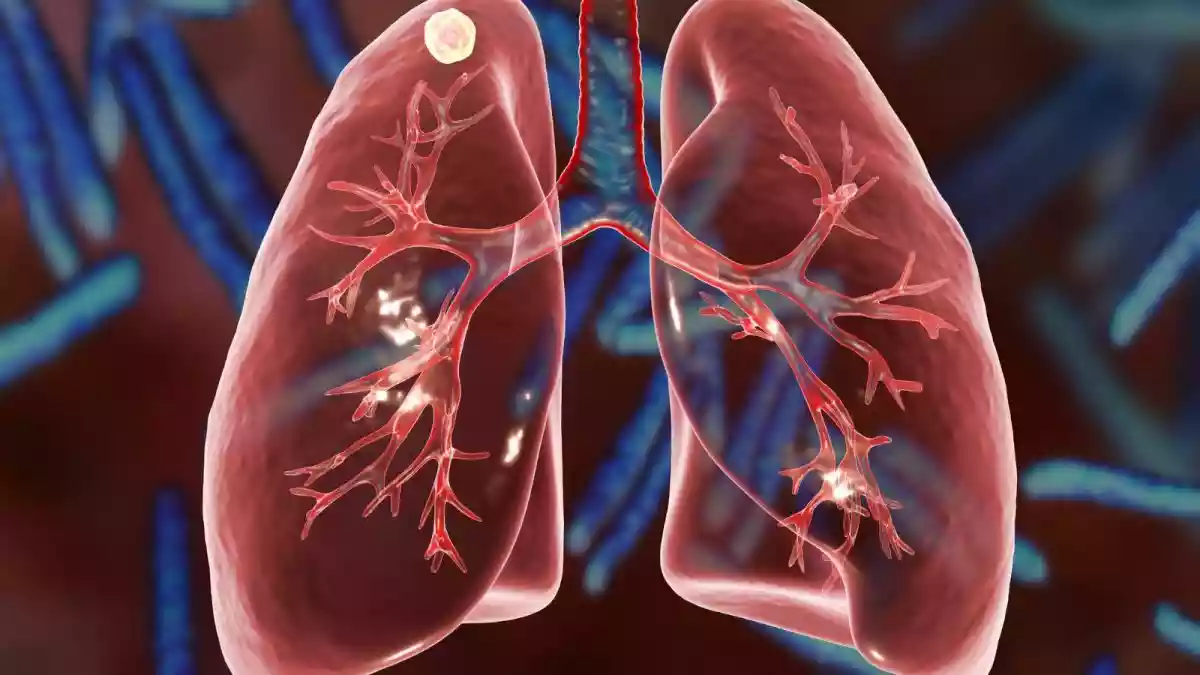 Lung and breathing diseases like tuberculosis, asthma, COPD, and pneumonia are common. However, there is a new lung infection called aspergillosis that is