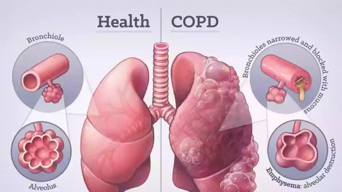 Why Winter Air Is Especially Dangerous For COPD Patients