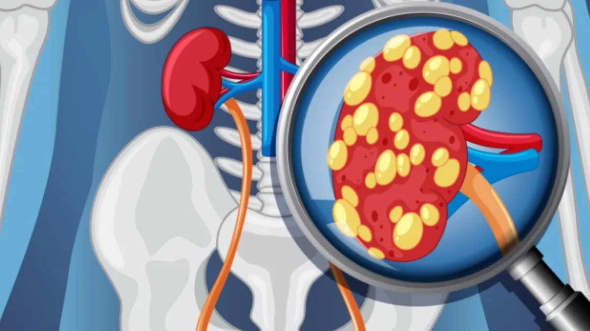 जब दुनिया पहले ही सेहत के मोर्चे पर इम्तिहान दे रही है, तब इस माहौल में एक बड़ी हेल्थ इमरजेंसी चुपचाप बढ़ रही है। आपकी जानकारी के लिए बता दें कि हम 'प्रोग्रेसिव किडनी डिजीज' के बारे में