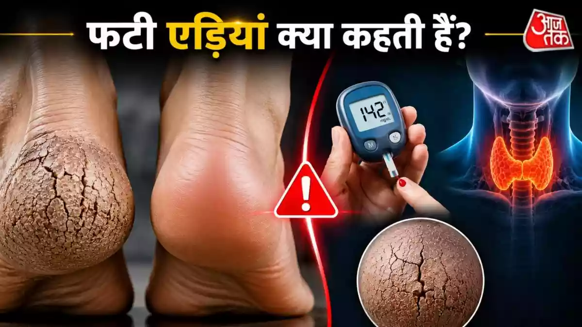 फटी एड़ियां सिर्फ ब्यूटी प्रॉब्लम नहीं हैं बल्कि कई बार शरीर अंदर से बीमारी का संकेत दे रहा होता है. यदि एड़ियां बार-बार सूख रही हैं, दर्द कर रही हैं या ठीक नहीं हो रही हैं तो इसे