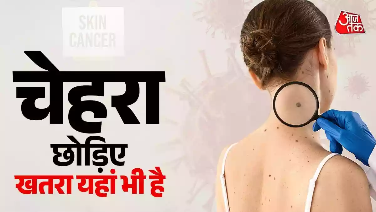 शरीर की इन छिपी जगहों पर भी हो सकता है स्किन कैंसर